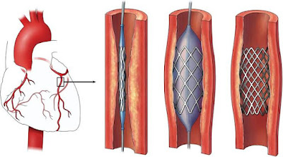 Myocardial Infarction