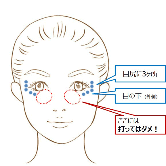 目尻と目の下のシワに対し杉崎がボトックスを打つ位置の例