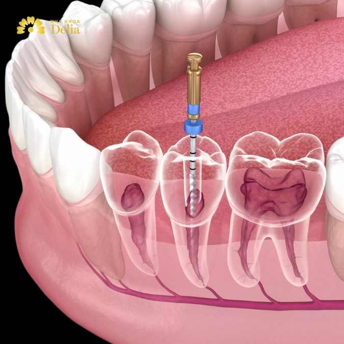 Lấy tủy răng giá bao nhiêu, bảng giá lấy tủy răng mới nhất 2024?