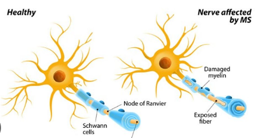 Multiple Sclerosis