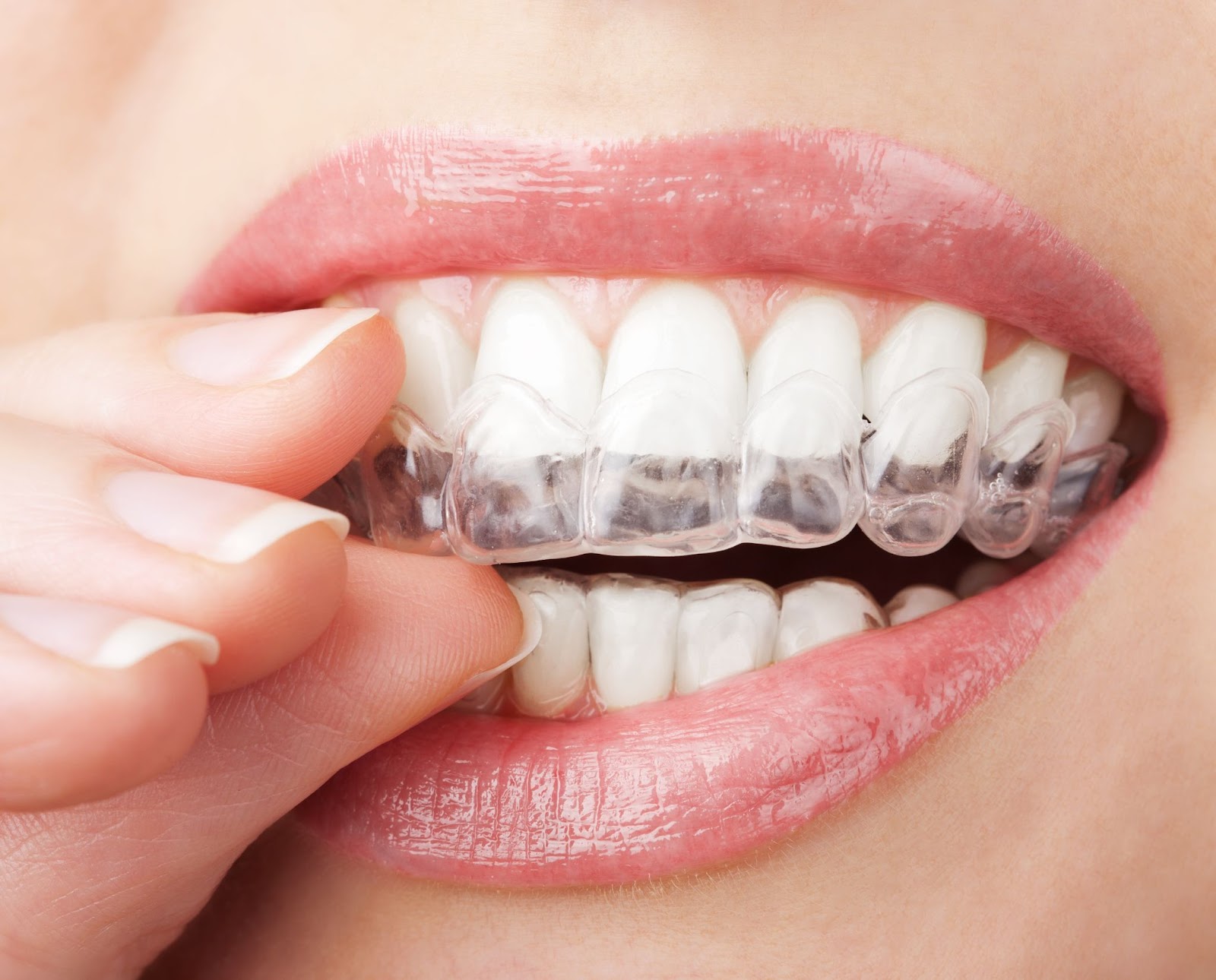A close up picture of a woman removing a teeth whitening tray from her teeth.