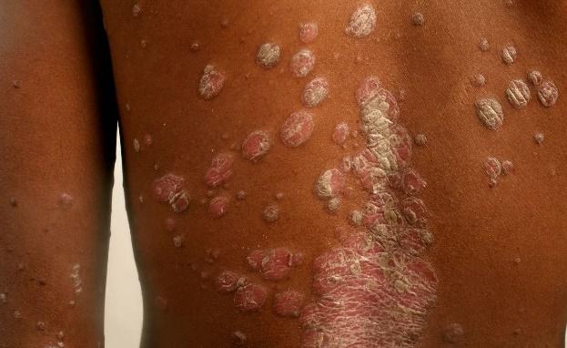 Psoriasis on Black Skin vs. White Skin: Causes, Diagnosis & Treatment