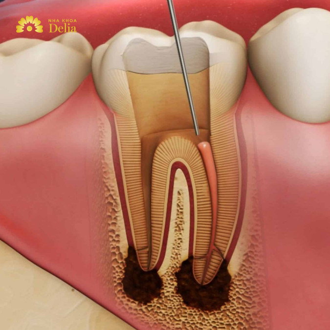 Lấy tủy răng là quy trình nhằm loại bỏ phần tủy răng bị nhiễm trùng hoặc tổn thương