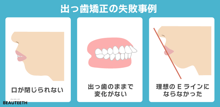 出っば矯正の失敗事例