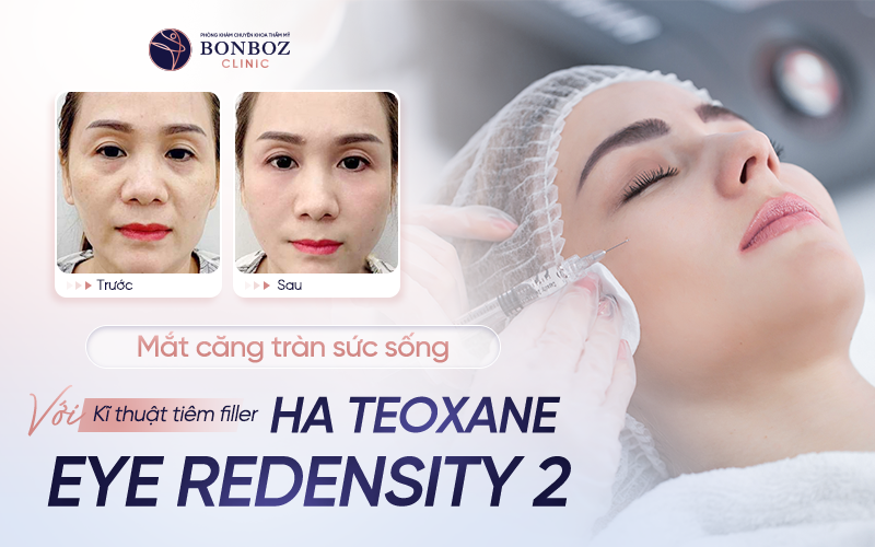 Mắt căng tràn sức sống với kỹ thuật tiêm filler HA Teoxane Eye Redensity 2