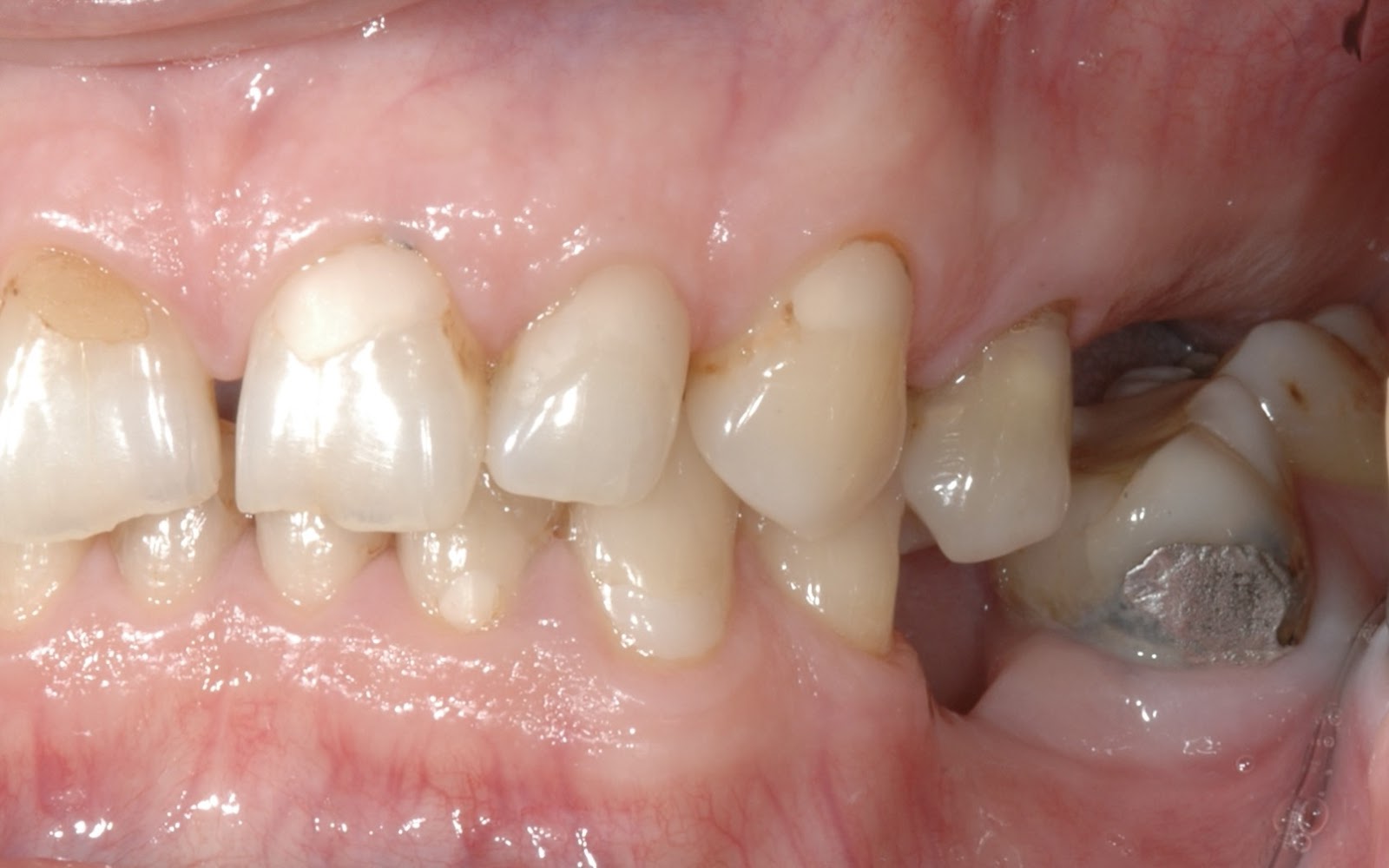 The Immediate Consequences of Tooth Loss