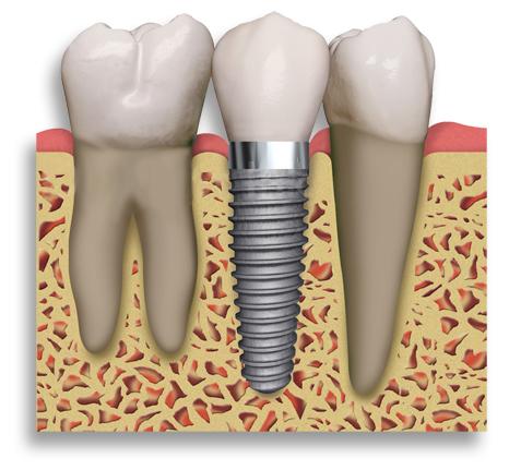 C:\Users\dara\Desktop\Dental Implant.jpg