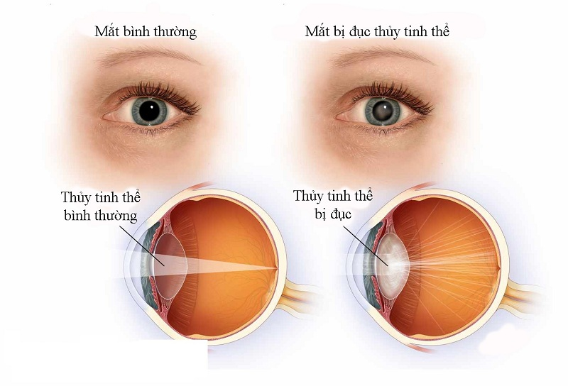 Người bị tiểu đường còn dễ bị đục thủy tinh thể gây mờ mắt
