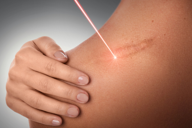 傷痕修正レーザー治療のメリットと注意点とは？
