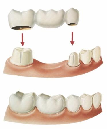 http://www.757dental.com/media/dental_bridge.jpg