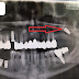 Hậu Quả Của Việc Cấy Ghép Implant Toàn Hàm Sai Kỹ Thuật