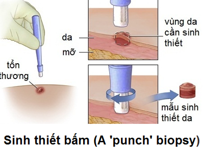 Sinh thiết bấm (Punch Biopsy)