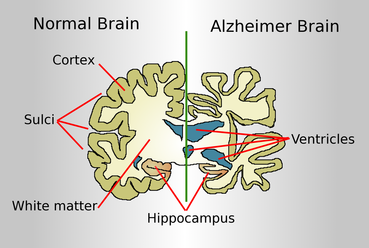 Alzheimer's Disease