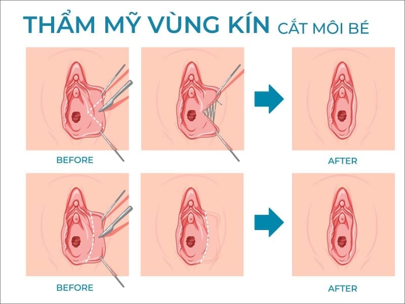 Khám phá lợi ích và rủi ro của phẫu thuật cắt môi bé vùng kín 