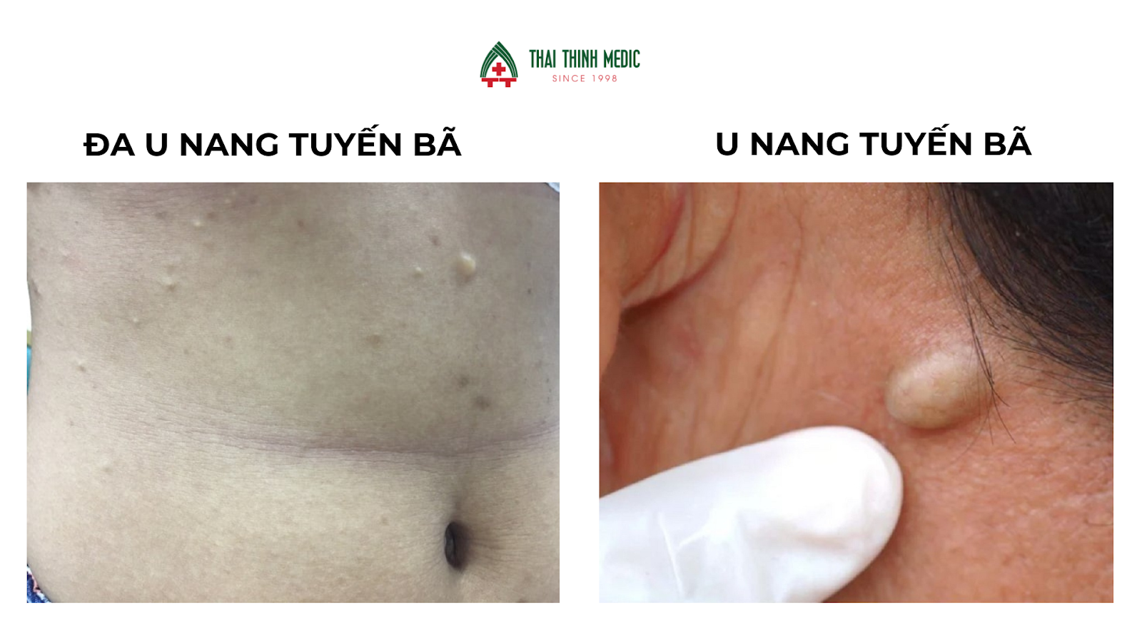u-nang-tuyen-ba-hieu--dung-va-xu-ly-kip-thoi-1