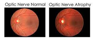 optic nerve atrophy