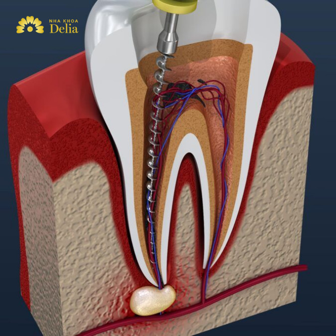 Nếu điều trị lần 1 chưa hoàn tất thì cần phải điều trị tủy thêm lần 2 hoặc lần 3