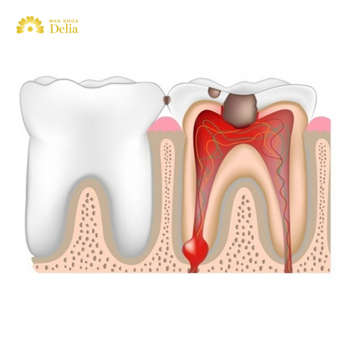 Viêm tủy hồi phục là giai đoạn nhẹ của viêm tủy răng