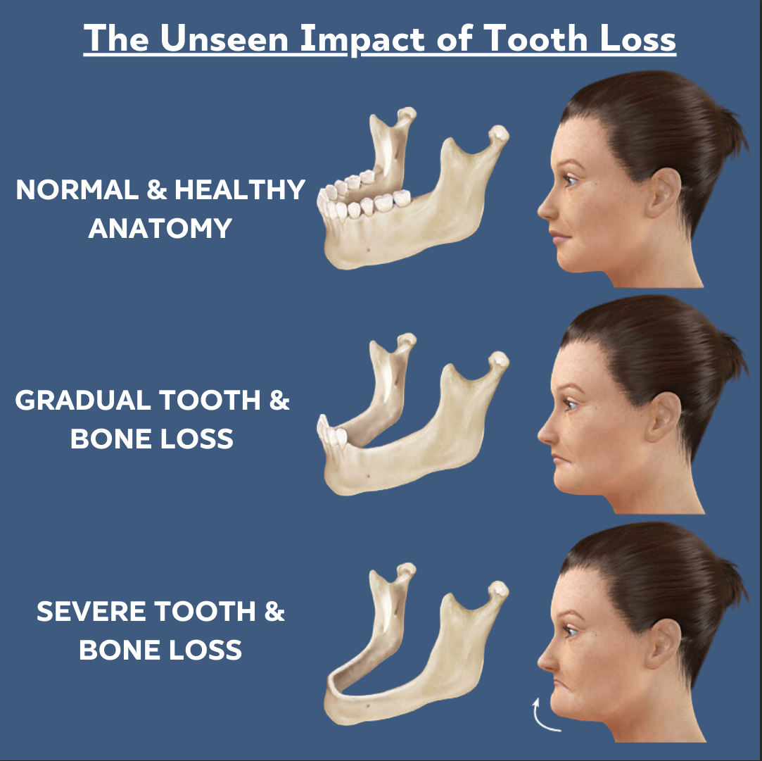 The Long-Term Consequences of Tooth Loss