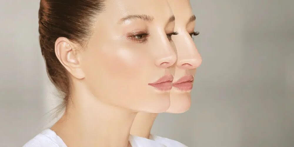 Procédure de rhinoplastie