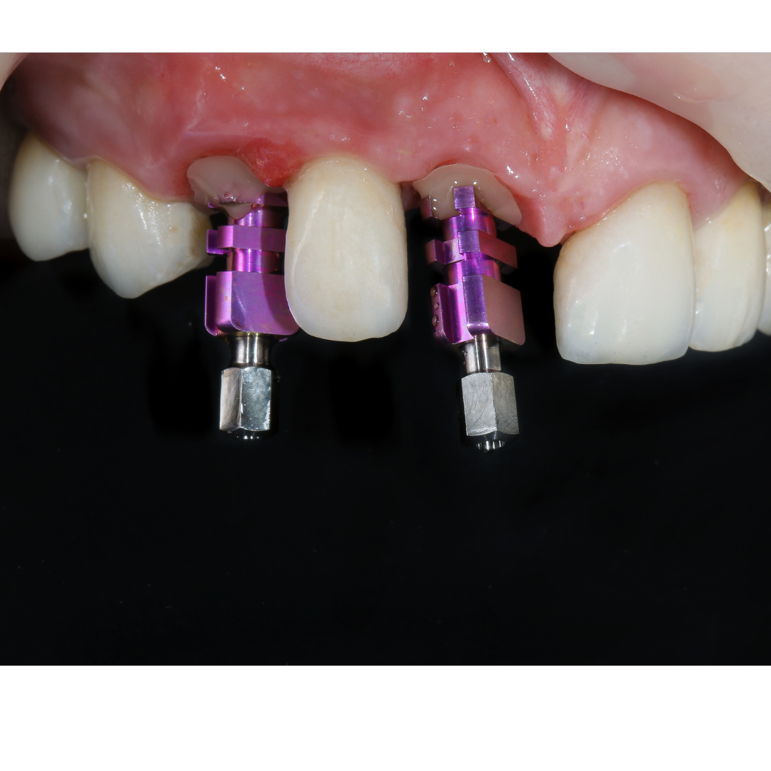 How Much Is a Full Set of Dental Implants