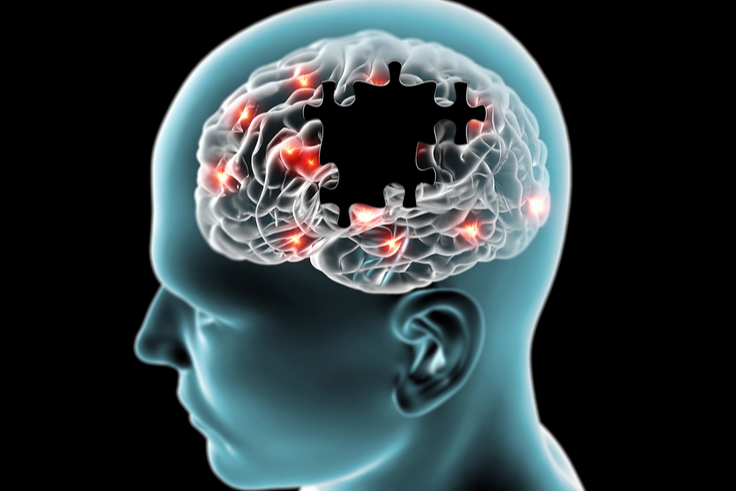 What are Neurodegenerative Diseases?