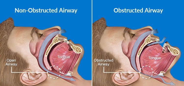 Sleep Apnea and Atrial Fibrillation: SLIIIP