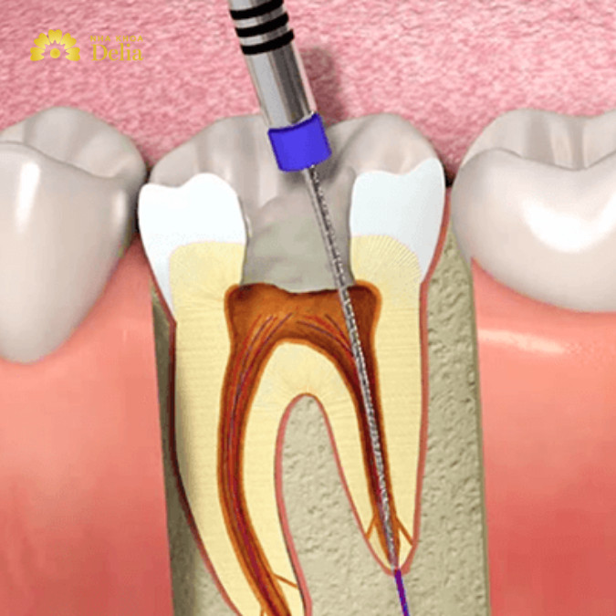 Răng đau sau khi đã lấy tủy do bác sĩ điều trị chưa triệt để