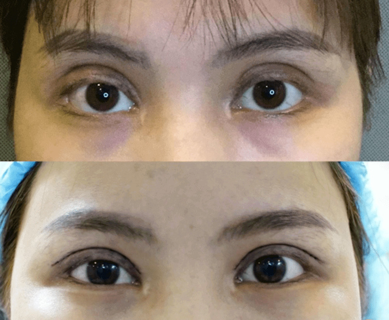 Cắt mí mắt bị trợn: Nguyên nhân, dấu hiệu và cách khắc phục