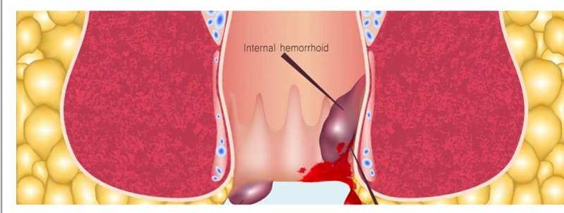 Internal Hemmoroids