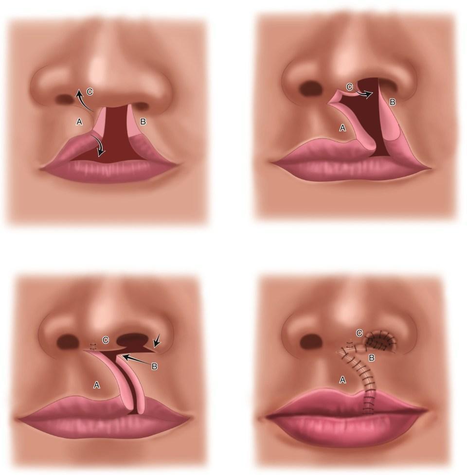 Cleft Lip and Palate