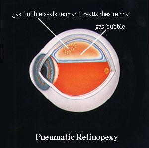 Image result for pneumatic retinopexy