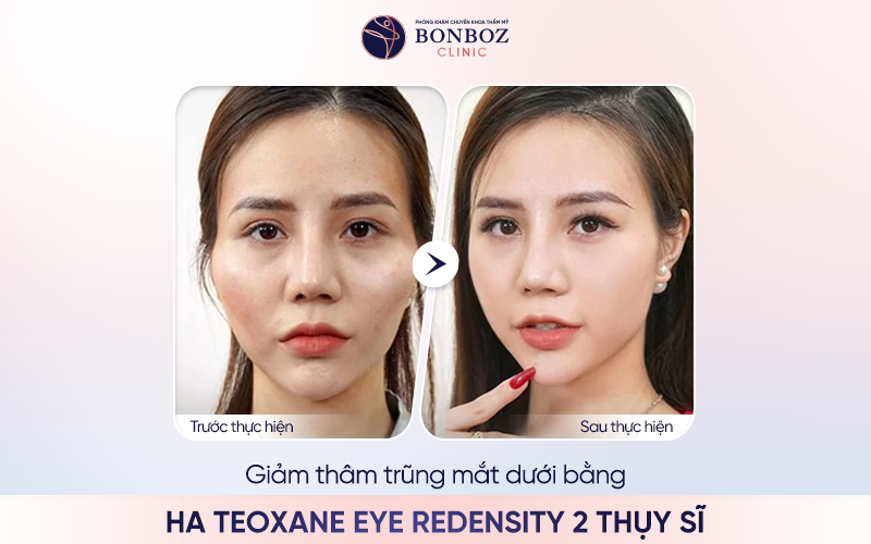 Hiệu quả sau khi giảm thâm trũng mắt dưới bằng HA Teoxane Eye Redensity 2 Thụy Sĩ tại BonBoz