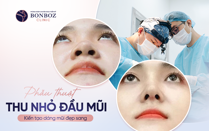 Phẫu thuật thu nhỏ đầu mũi - “Kiến tạo” dáng mũi đẹp, sang 