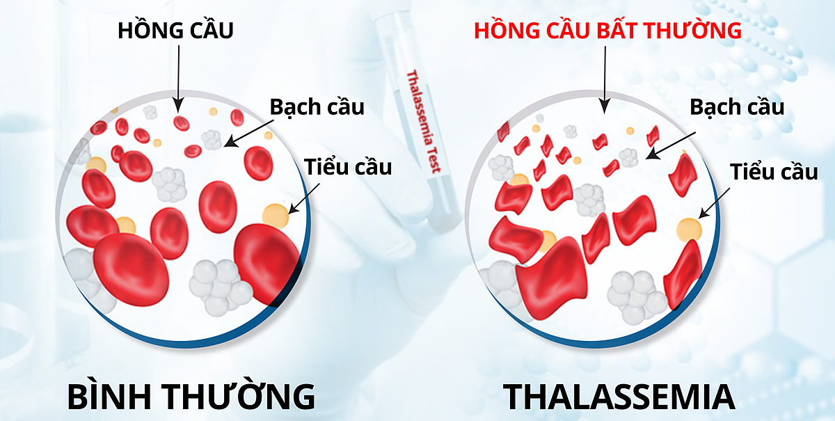 Bệnh Thalassemia có thể làm kết quả HbA1c tăng cao hơn mức thực tế