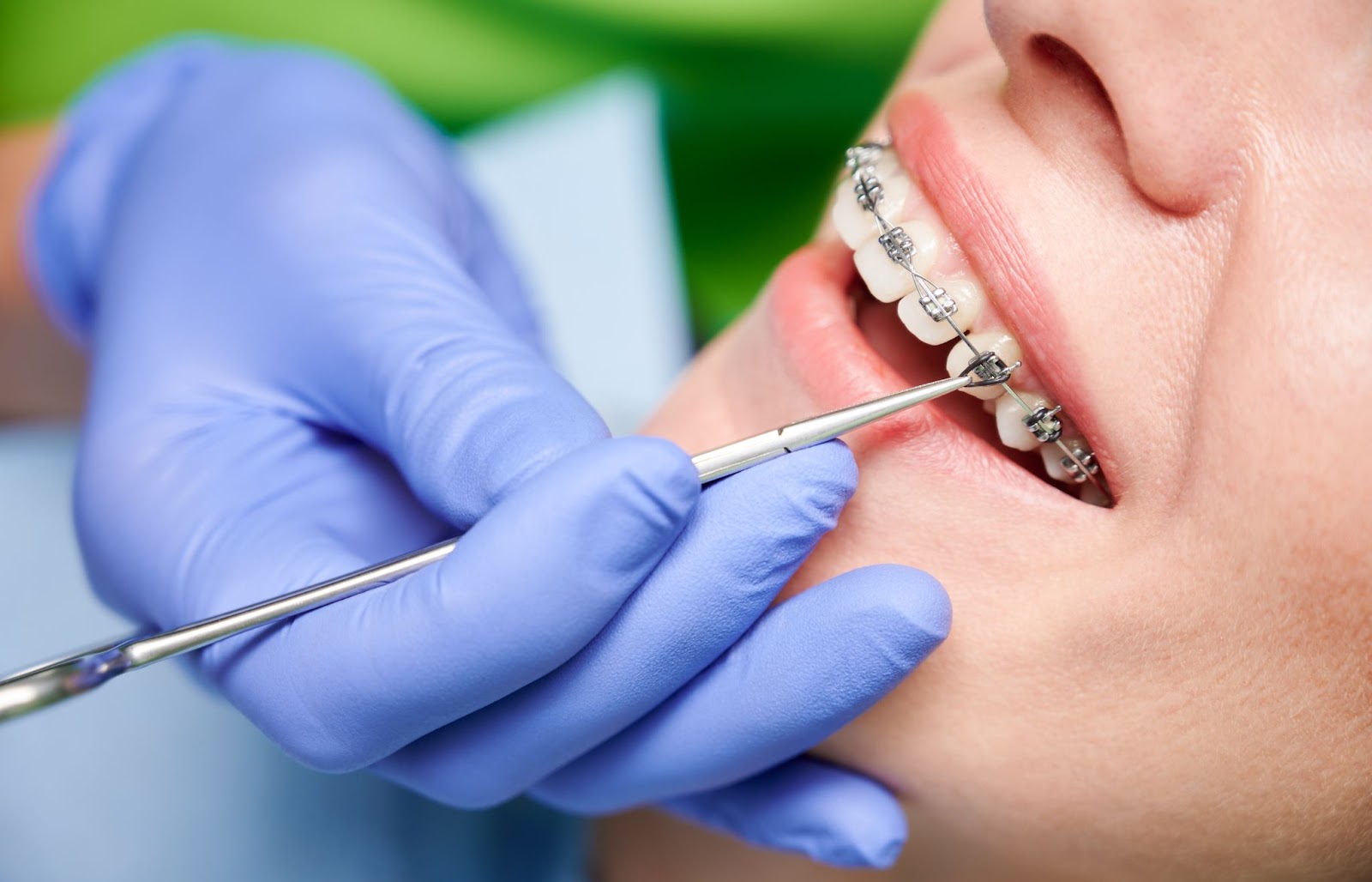 A closeup picture of a dentist's hand holding a tool to adjust braces on someone's teeth.