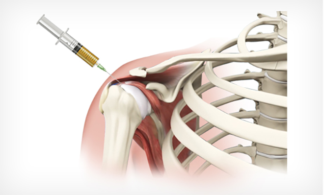 Stem Cell Therapy for Rotator Cuff