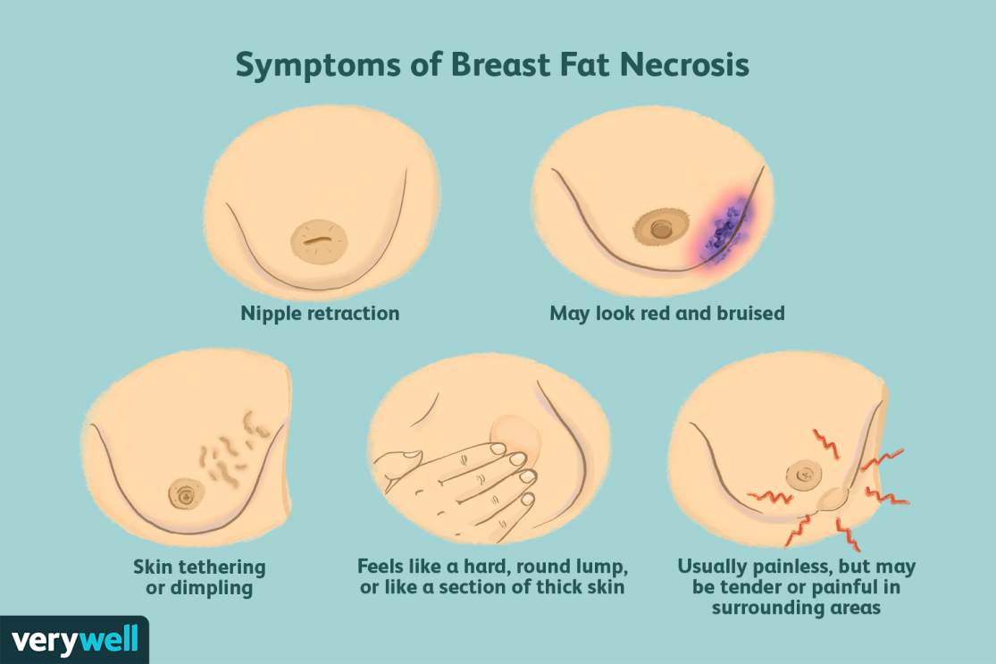 Breast Fat Necrosis: Signs, Causes, Diagnosis, Treatment