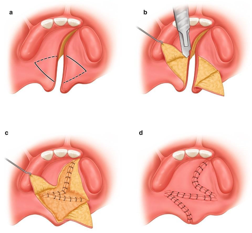 Cleft Lip and Palate