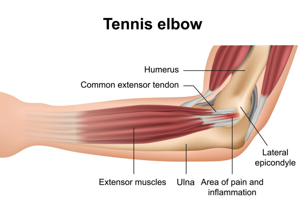 Tennis Elbow
