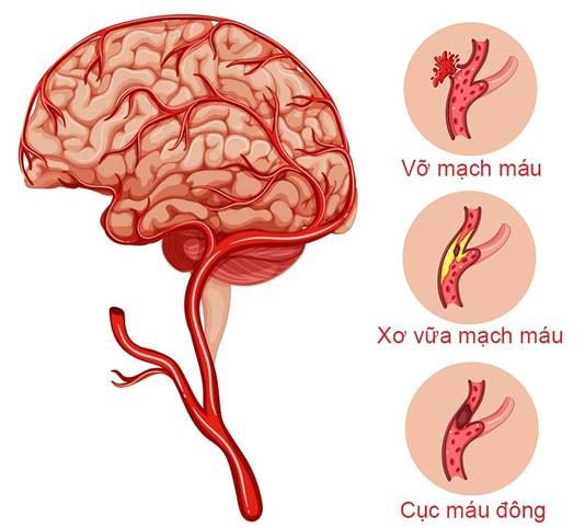  Đột quỵ xuất huyết não do vỡ mạch máu não, nhồi máu não do tắc nghẽn mạch máu não