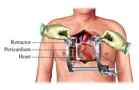 Open Heart Surgery Diagram - For Patients & Caregivers