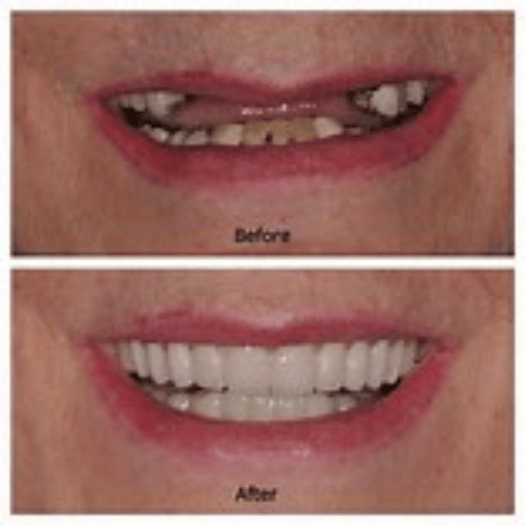 How Do Dental Implants Work