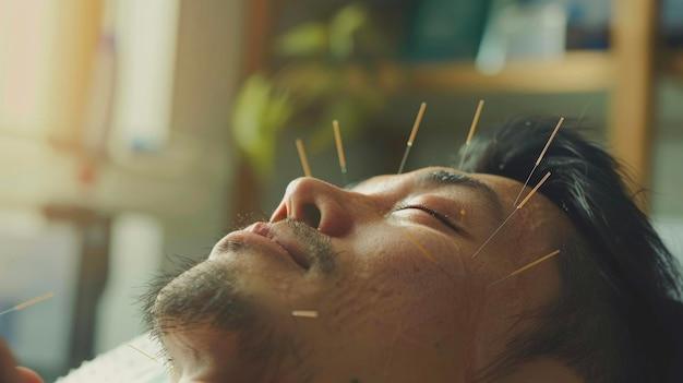 A person receiving acupuncture a healing practice originating from ancient chinese traditional