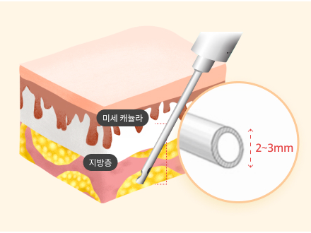 초미세캐뉼라.png