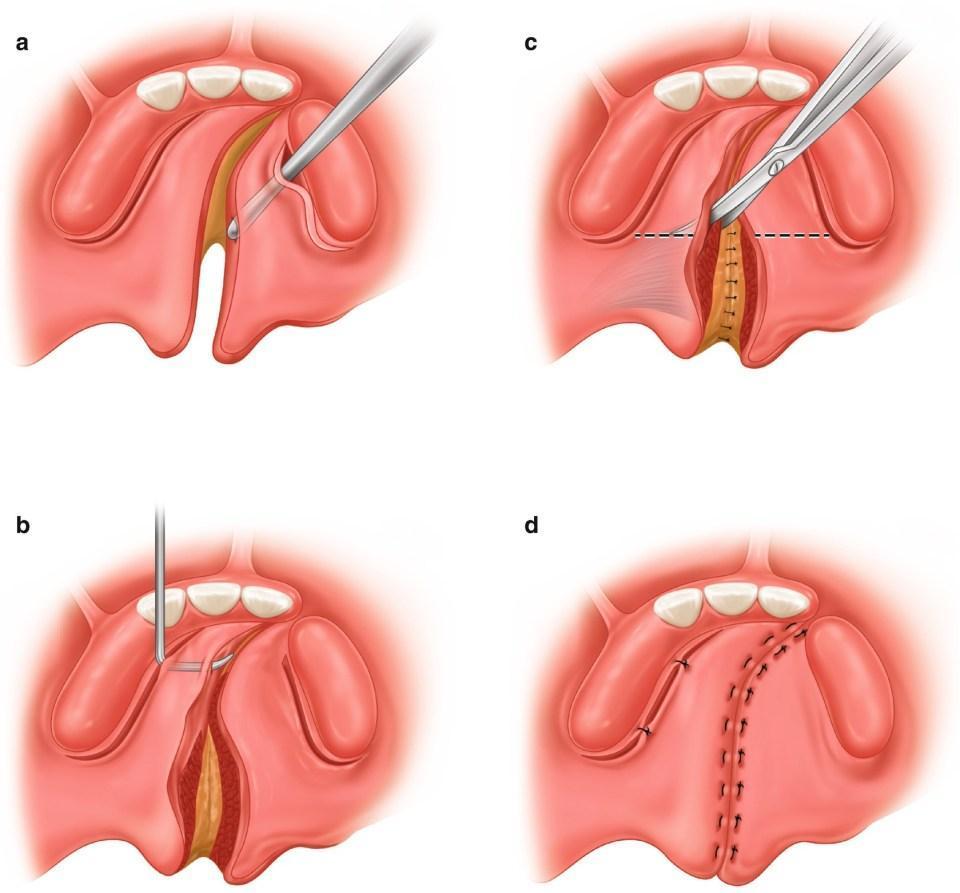 Cleft Lip and Palate