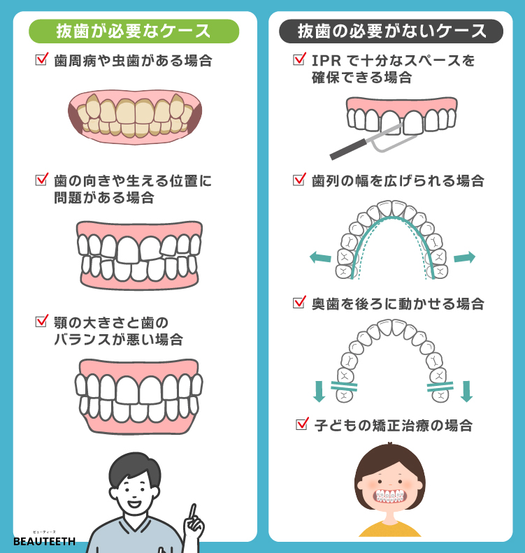 インビザライン矯正で抜歯が必要な例と不要な例