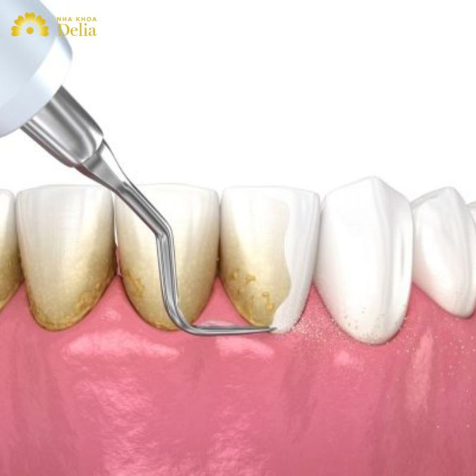 Việc sử dụng dụng cụ không phù hợp hoặc kỹ thuật lấy cao răng không chính xác có thể làm tổn thương men răng