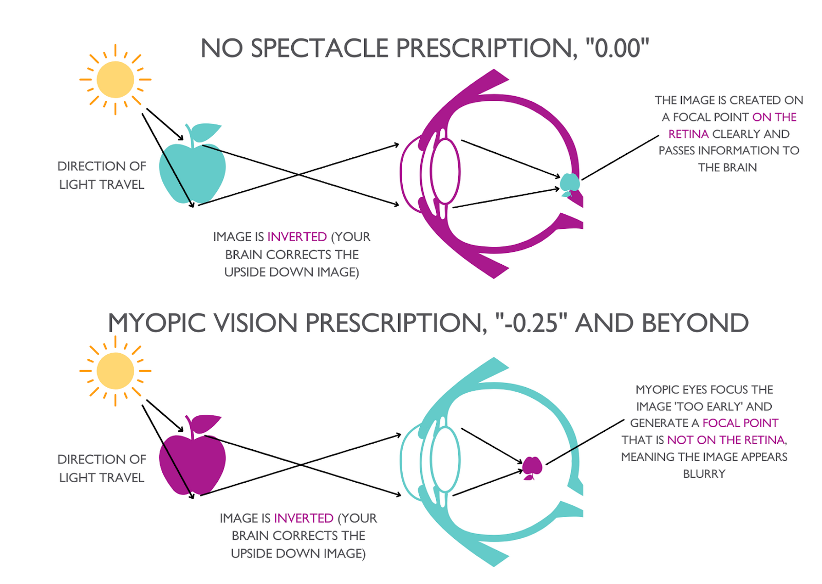 Mild myopia: -0.25 to -3.00 (Source: https://www.leightons.co.uk/eye-care/myopia-management)