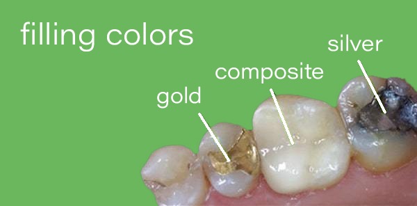 Dental Sealants